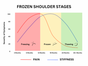 Frozen shoulder stages showing pain and stiffness severity over time during freezing, frozen and thawing phases
