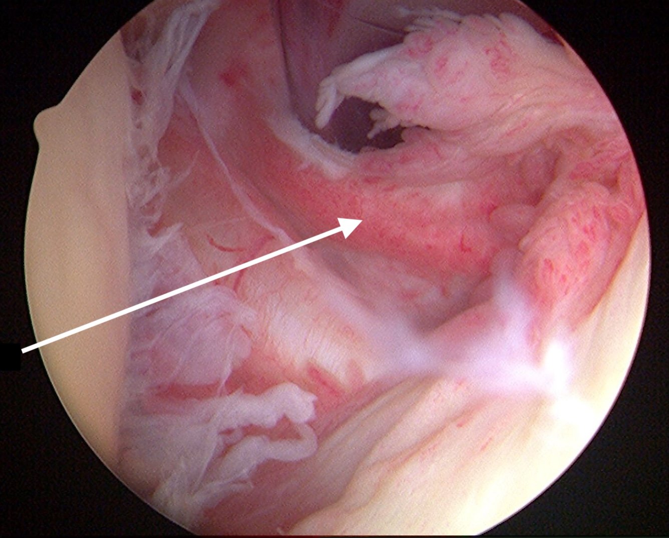 Arthroscopic view of the shoulder capsule showing the target area for frozen shoulder injection