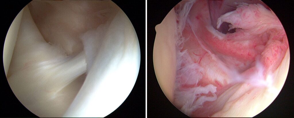 Frozen shoulder arthroscopy showing capsule inflammation Arthroscopic view comparing a normal shoulder joint with frozen shoulder showing inflamed thickened capsule in adhesive capsulitis