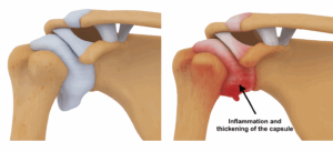 Illustration showing inflammation and thickening of the shoulder capsule in frozen shoulder compared to a normal shoulder