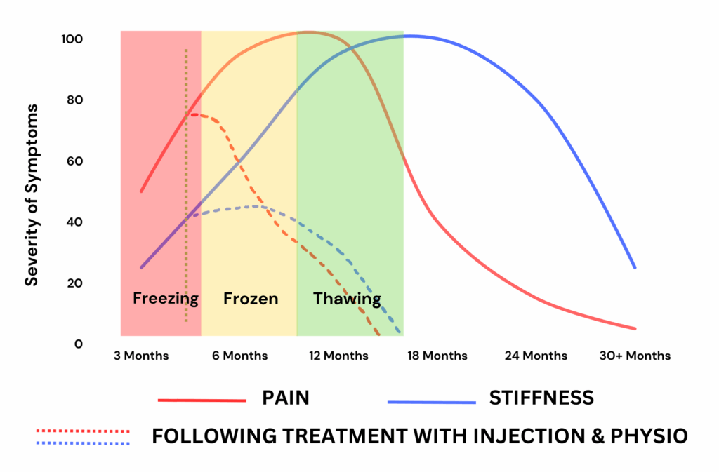 Graph showing pain and stiffness improvement in frozen shoulder following cortisone injection and physiotherapy