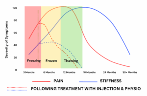 Graph showing pain and stiffness improvement in frozen shoulder following cortisone injection and physiotherapy