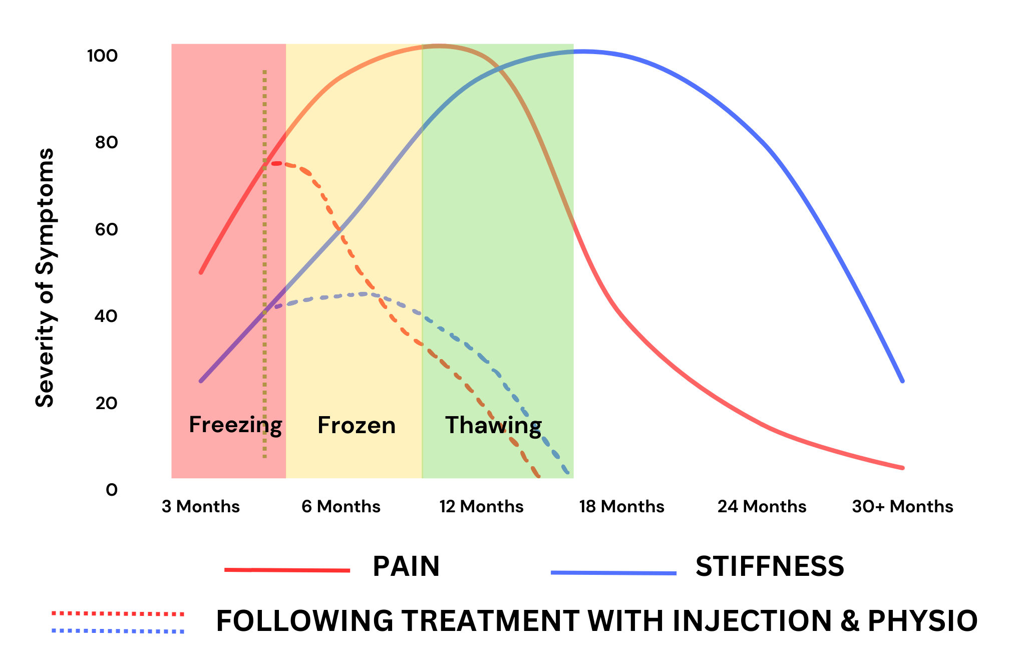Graph showing pain and stiffness improvement in frozen shoulder following cortisone injection and physiotherapy