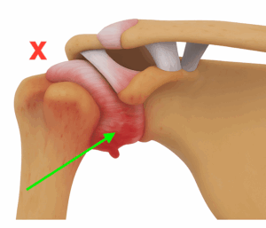 Diagram showing frozen shoulder injection targeting the inflamed shoulder capsule (green arrow) rather than the subacromial bursa (red cross)