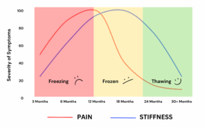 Frozen shoulder stages showing pain and stiffness severity over time during freezing, frozen and thawing phases