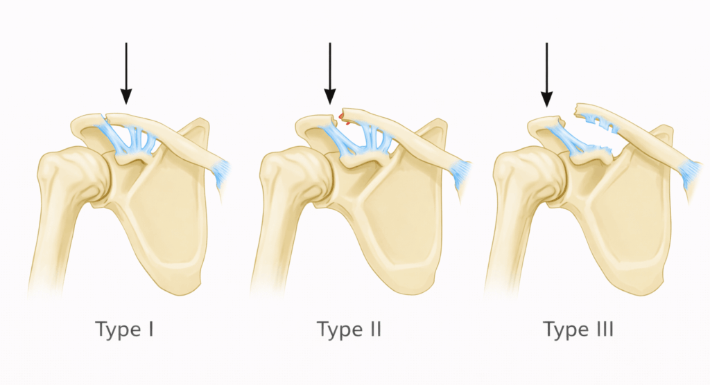 Diagram showing Type I, Type II, and Type III acromioclavicular joint injuries of the shoulder