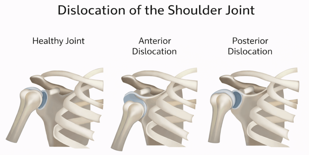 Shoulder dislocation anatomy diagram Diagram showing healthy shoulder joint compared with anterior and posterior shoulder dislocation